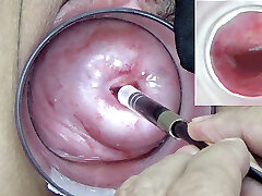 A endoscope japanese camera is rammed in the cervix to watch inside the uterus.