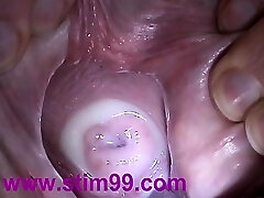 Insertion Semen in Cervix Cunny Speculum. Cum in Uterus