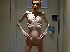 Anorexia Christin showing her Weenies & Skinny Skeleton