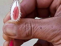 Insertion uretre Insertion uretre