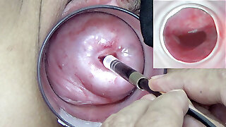 A endoscope chinese camera is inserted in the cervix to witness inside the uterus.