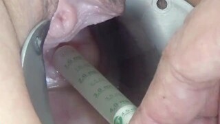 Injection of Semen with Syringe into Uterus