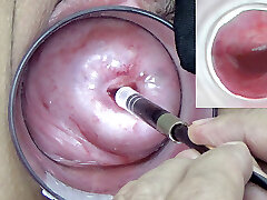 A endoscope japanese camera is inserted in the cervix to watch inside the uterus.