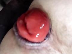Prolapse 1