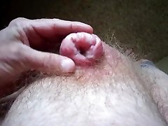 my view penectomy