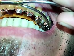 new braces and twinblock with headgear for new aventures