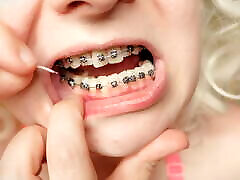 2nd day in braces - dental floss - close up mouth tour