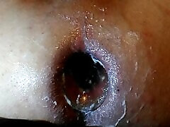 dilatation anal