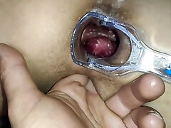Developed An Anal Phallus And Got A Penis With An Examination Of The Anal With A Medical Mirror
